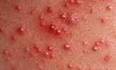 Steroid Acne